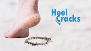 What Causes Dry Cracked Heels and Feet?