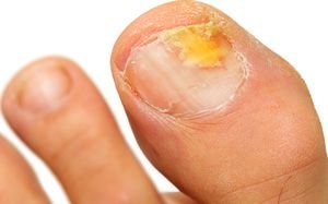fungal nail of feet