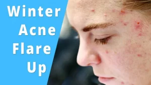 Winter Acne Flare Up (Know Everything to Stay Safe)