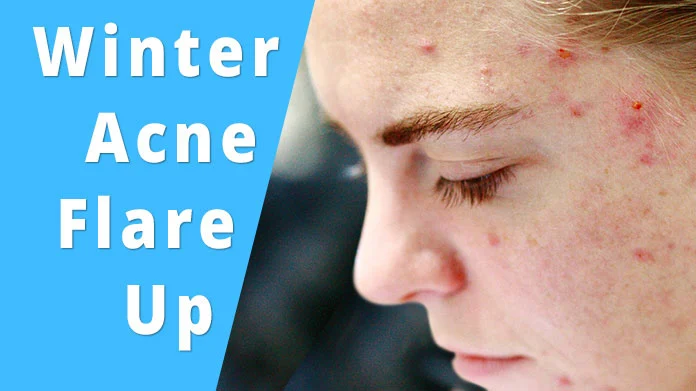 winter acne flare up