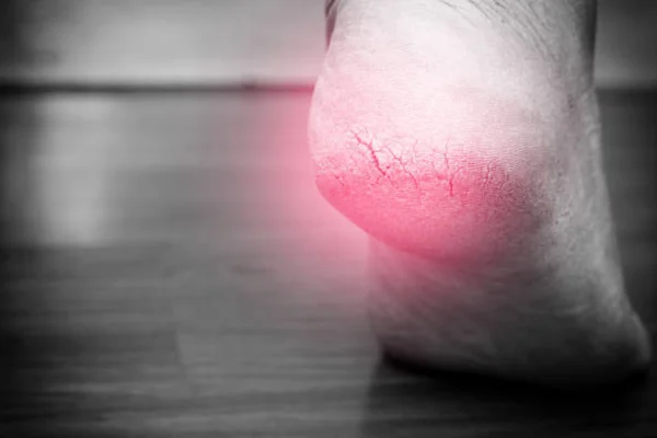 Is Heel Pain A Sign Of Cancer